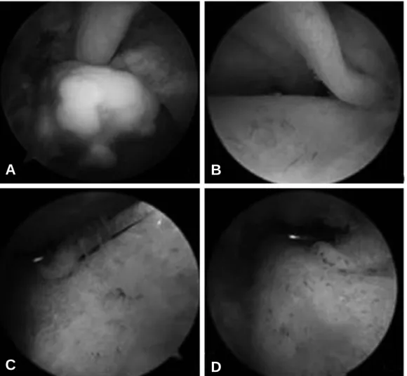 Figure 3. Tendosopic findigs of a 57 years-old male patient with FHL tenosynovitis. (A) An osseous loose body, (B) degenerated vinculae, (C), (D) and the development of inflammatory tissues within the tendon sheath is observed.