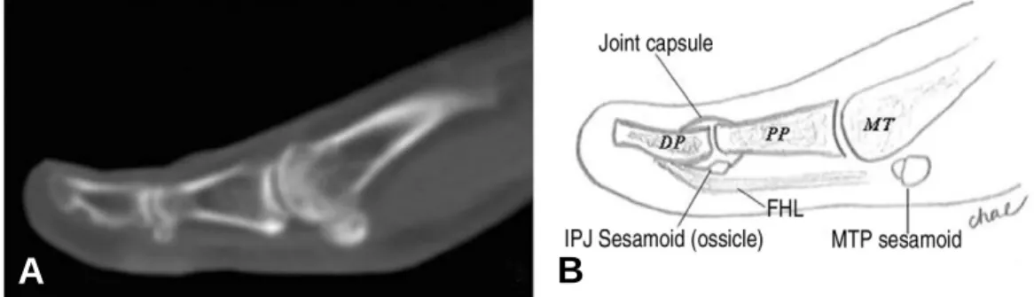 Figure 3. (A) The photo of plantar surface of hallucal proximal phalanx with no visual keratoses