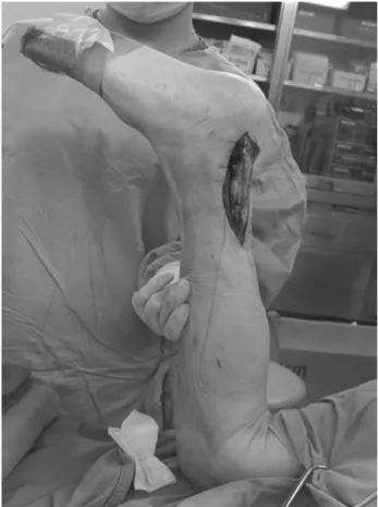 Figure 1. We adjusted core suture tension by 10 degrees of plantar flexion compared to contralateral side with 90 degrees of knee flexion.