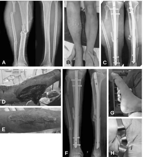 Figure 1. A patient with a mid-shaft tibia fracture and a segmental fibular fracture in right leg, and a proximal fibular fracture in left leg (A,  B) showed severe swelling and multiple bullae formation of right leg compared to the left leg