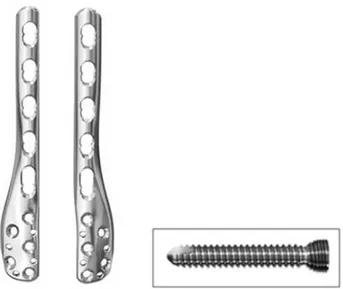 Figure 1. implant: (Lateral Distal Fibula Plate ,Synthes � ) and 2.7 mm, 3.5 mm locking screw, self-tapping.