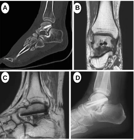 Figure 3. (A) Postoperative CT image shows the good reduction of fracture and peritalar joint alignment