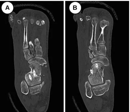 Figure 4. (A, B) Postoperative CT images of 39 years old male patient show the inappropriate positioning of posteroanterior compression screws