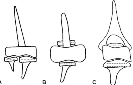 Fig. 2. The Kudo unlinked total elbow arthroplasty (Biomet).
