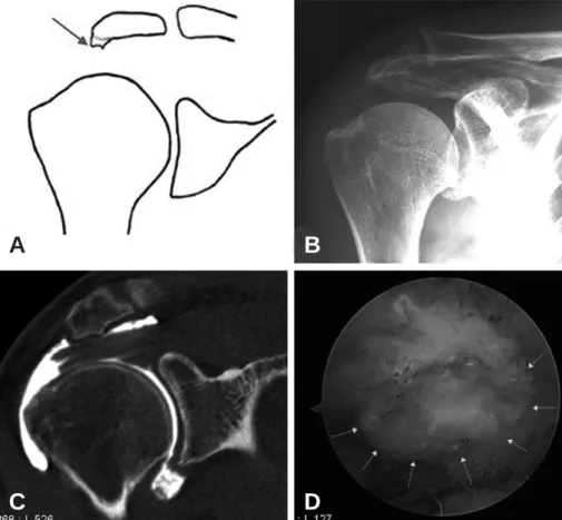 Fig. 1. Heel type spur was shown in the (A) schematic diagram (B) plain radiograph (C) MRI and (D) arthroscopy (yellow arrow: margin of heel type spur).