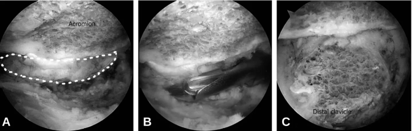 Fig. 4. Multiple channeling of the footprint of rotator cuff tendon was shown. The channels are created by the bone punch of diameter 2.1 mm with 4~5 mm apart and 10 mm deep