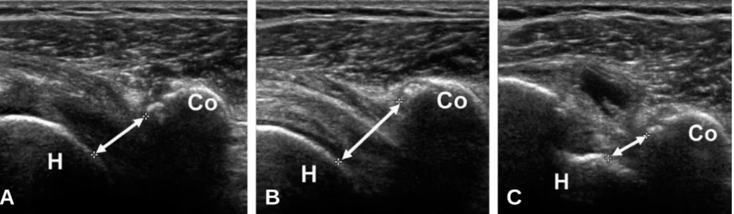 Fig. 5. The dynamic coracohumeral distances (CHD) were measured using ultrasonography with the arm in neutral rotation (A), in full external rotation (B) and in full internal rotation (C)