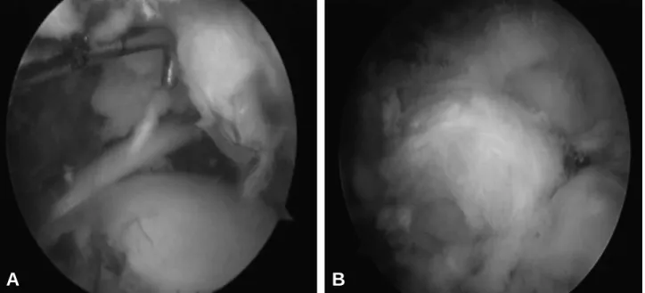 Fig. 1. (A) Arthroscopic images showing medium sized (20×15 mm) full thickness tear at the tendinous portion of the supraspinatus muscle, (B) Arthroscopic image after rotator cuff repair using transosseous equivalent technique.