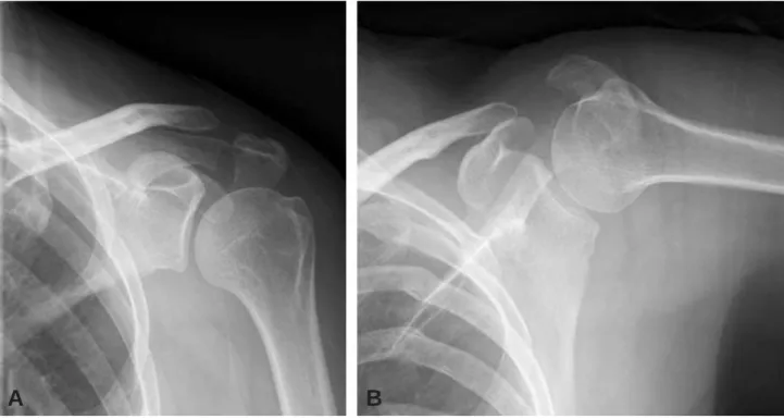 Fig. 2. (A) Anteroposterior, (B) and axillary lateral radiographs of the left shoulder taken at sixteen months after injury show displaced acromial fracture.