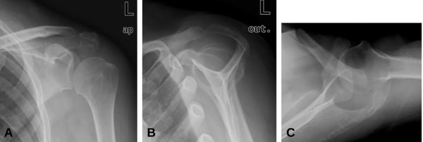 Fig. 4. (A) Anteroposterior, (B) supraspinatus outlet and (C) axillary lateral radiographs after implant removal at nine months after operation.
