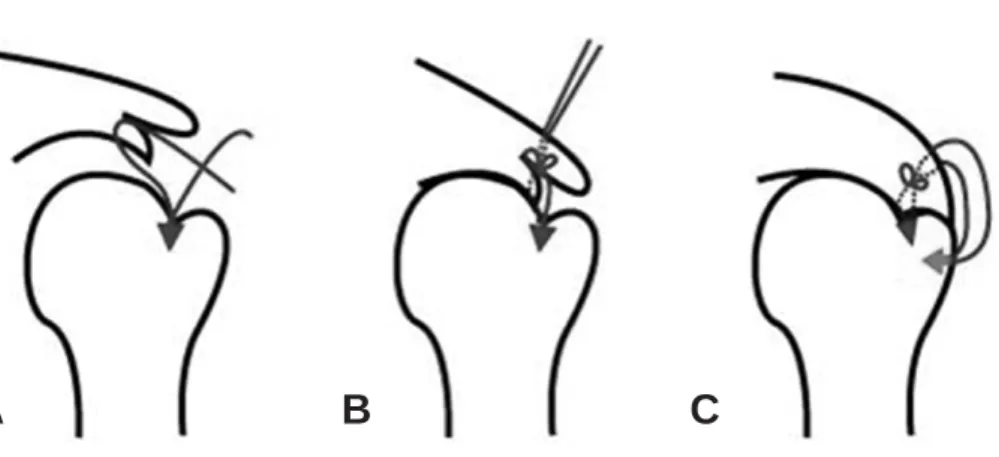 Fig. 1. Schematic, step-by-step illustration of arthroscopic layered suture bridge repair