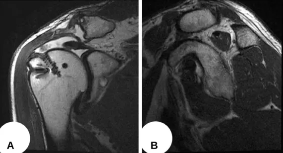 Fig. 5. Arthroscopic images of a right shoulder with delamination of the rotator cuff