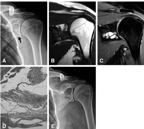 Fig. 1. (A) Radiograph of the left shoulder shows a well-defined and multilobular radiolucent osteolytic lesion at the inferior portion of the glenoid (arrow)