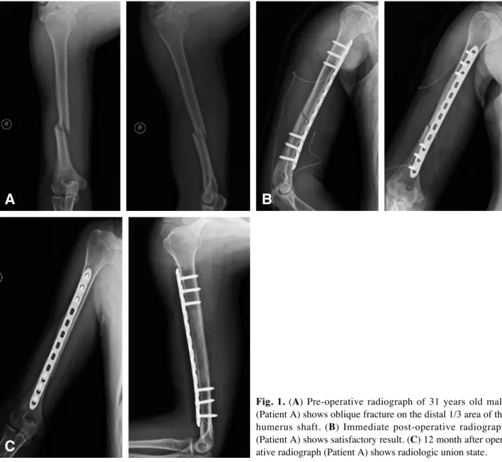 Fig. 1. (A) Pre-operative radiograph of 31 years old male (Patient A) shows oblique fracture on the distal 1/3 area of the humerus shaft