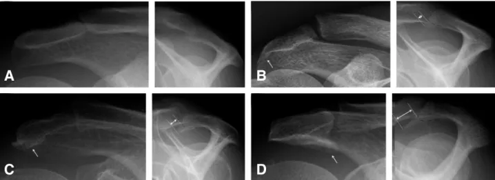Fig. 1. Simple radiographic findings were classified as grading of degenerative changes in acromion