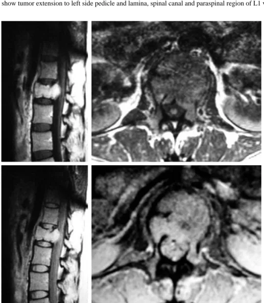 Fig. 3. MRIs show collapsed L1 vertebral body, and dural sac around L1 vertebra was surrounded and compressed by tumor.