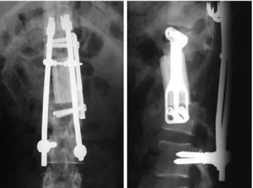 Fig. 4. Post operative x-rays show total spondylectomy with structural allograft fixed with Z-plate and CD instru- instru-ments from D11 to L3 vertebrae.