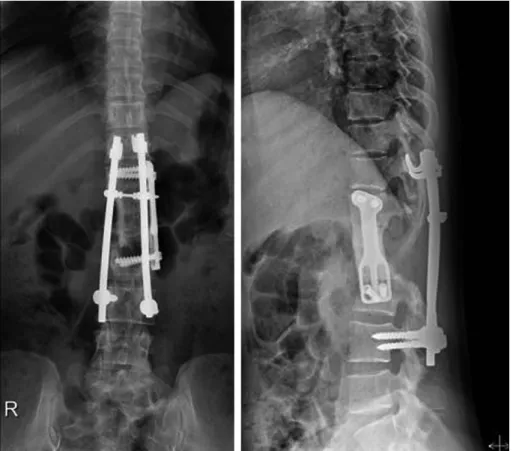 Fig. 5. Last follow-up x-rays at post-operative 18 years show well maintained Z-plate and CD instruments with remodelling of structural allograft to host vertebral bone.