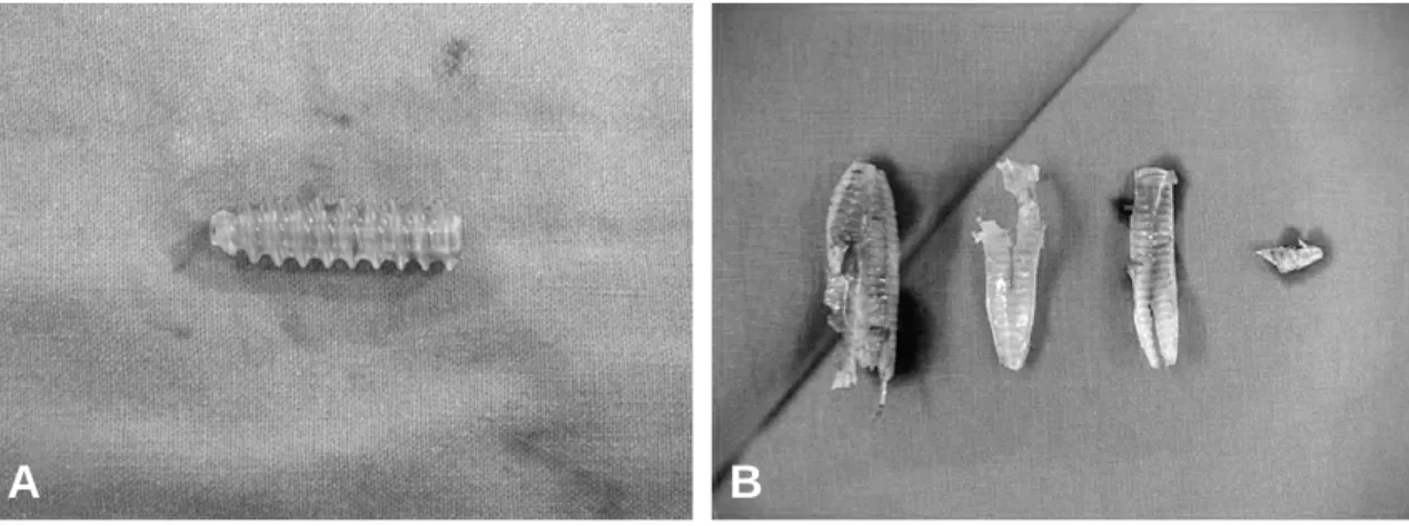 Fig. 5. Microscopic findings of soft tissue from cyst show degenerated amorphous material (H &amp; E stain,×100).