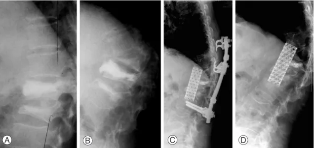 Fig. 1. (A) PVP was performed for T11 and T12 compression fractures. (B) Subsequent refracture with severe angular kyphosis and  IVC developed after 10 months of PVP