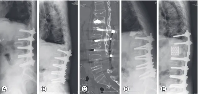 Fig. 2. (A) This 61-year-old female patient underwent instrumented lumbar fusion 10 years ago