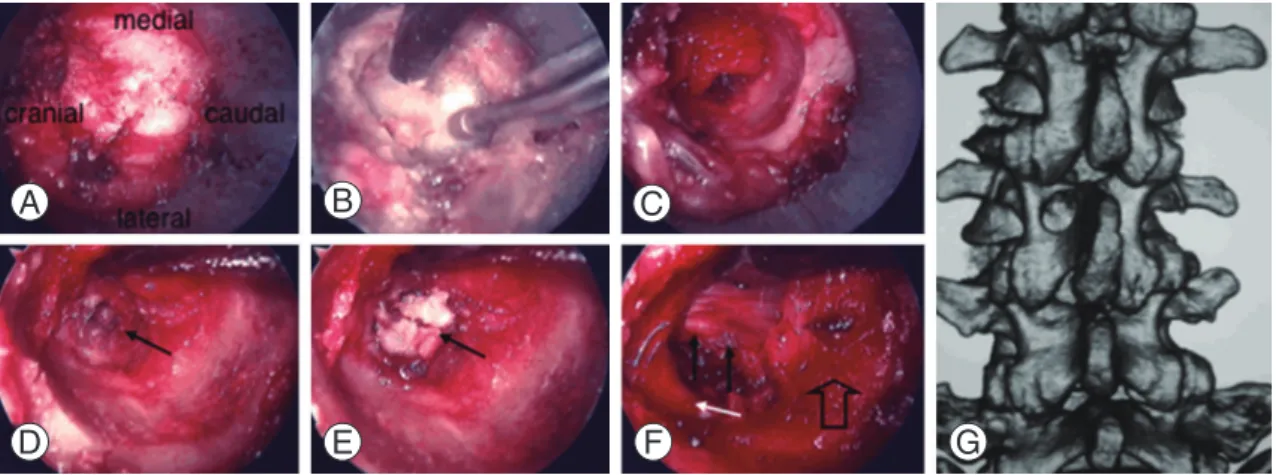 Fig. 2. Intraoperative photographs and a postoperative three-dimensional (3D) computed tomography (CT) scan of case 6