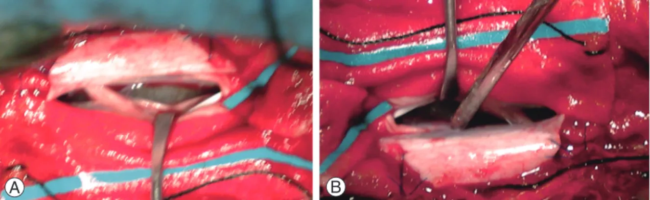 Fig. 3. (A) Intraoperative view showing a grayish translucent cyst in front of the cord