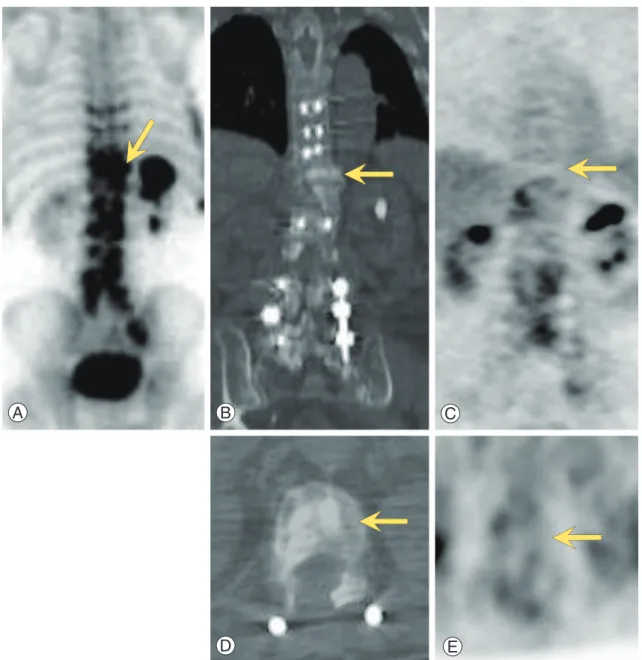 Fig. 1. Bone scan (A), CT, (B, D) and FDG PET (C, E) images of a 77-year-old man with prostate carcinoma