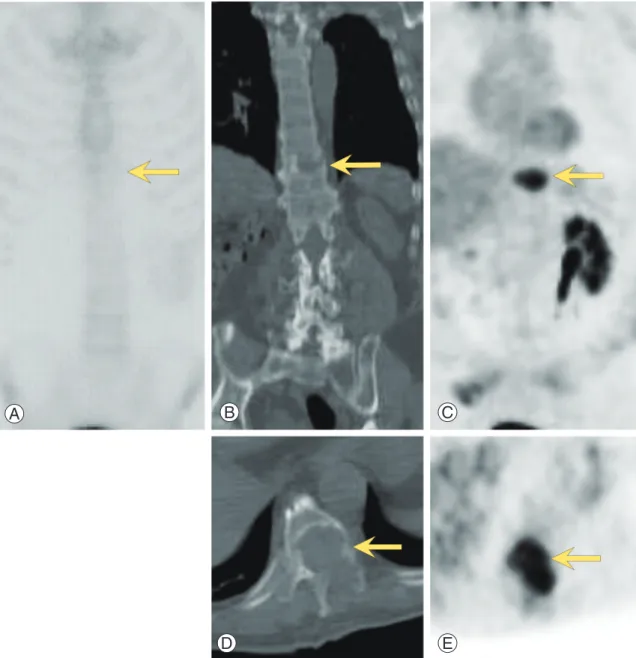 Fig. 2. Bone scan (A), computed tomography (CT) (B, D) and fluorodeoxyglucose (FDG) positron emission tomography (PET) (C, E)  images of a 69-year-old man with renal cell carcinoma