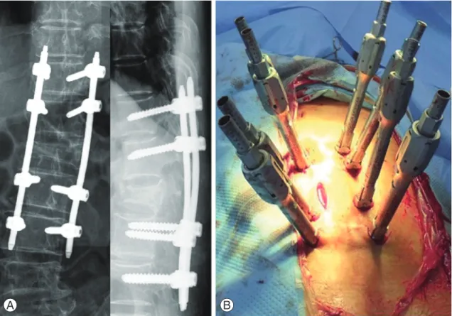 Fig. 1. (A) On postoperative radiographs, stable fixation using percutaneous long-segmental posterior instrumentation was ob- ob-served