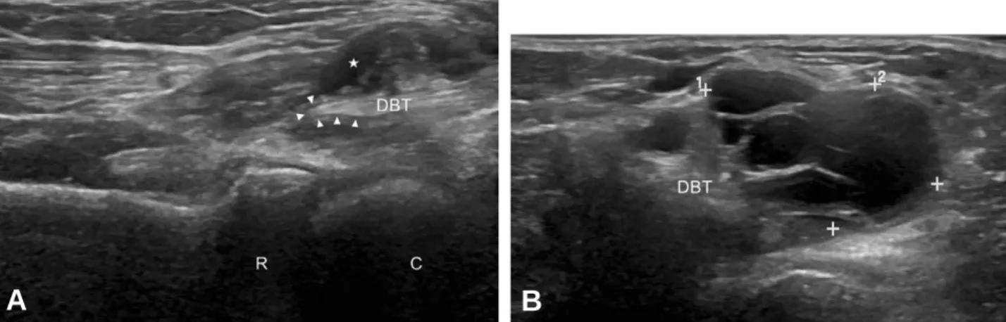 Fig. 1. (A) Long axis image of distal biceps tendon tear is combined with bicipitoradial bursitis ( ★)