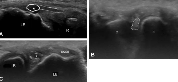 Fig. 3. (A) Long axis image shows a partial thickness tear of the lateral ulnar collateral ligament with a hypoechoic scar in continuity ( ★) and normal lateral ulnar collateral ligament (dot line)