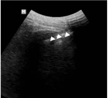 Fig. 14. Needle (arrowheads) is inserted into sacroiliac (SI) joint behind posterior acoustic shadow of PIIS for SI joint injection.