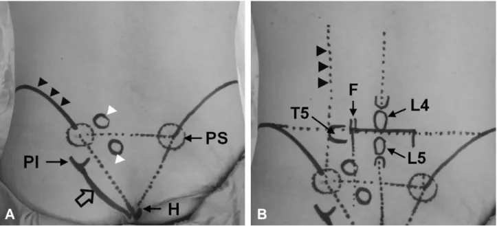 Fig. 1. (A) Surface anatomy of sacral region. PS; posterior superior iliac spine (PSIS), PI; posterior inferior iliac spine (PIIS), H; sacral hiatus, open arrow; lateral margin of sacrum, white arrowhead; sacral foramen, black arrowheads; iliac crest