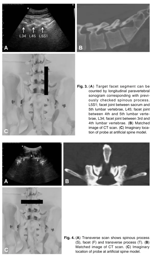 Fig. 3. (A) Target facet segment can be counted by longitudinal paravertebral sonogram corresponding with  previ-ously checked spinous process.