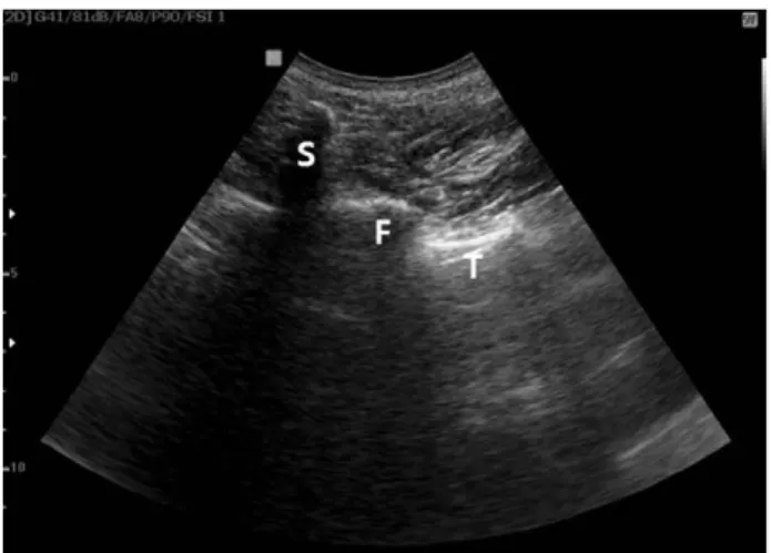 Fig. 6. (A) Ultrasonography on transverse scan at PIIS(posterior inferior iliac spine) shows deep flat sacral cortex (S) in left aspect and PIIS (P) like a high mountain with posterior acoustic shadow in right