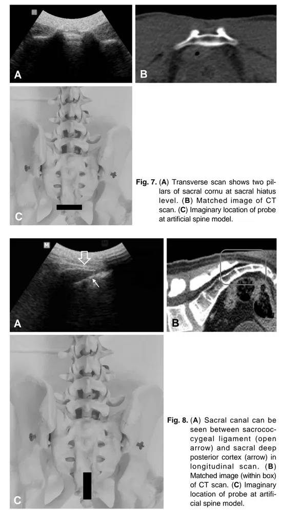 Fig. 7. (A) Transverse scan shows two pil- pil-lars of sacral cornu at sacral hiatus level