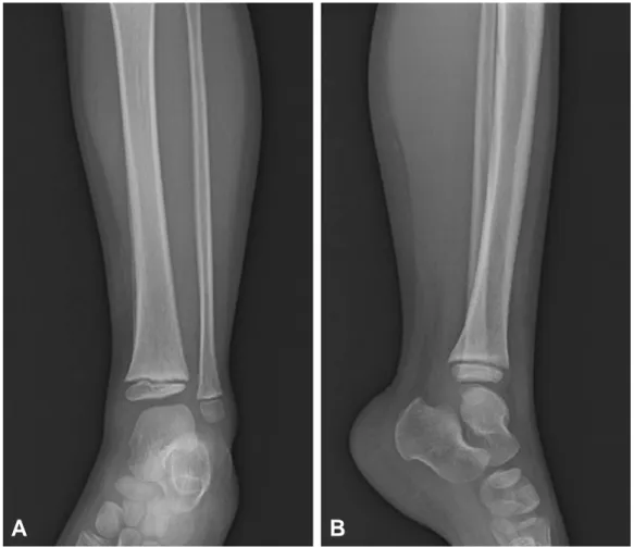 Fig. 3. (A, B) The radiographs reveal periosteal reaction along the medial tibial border after three-weeks of drainage.
