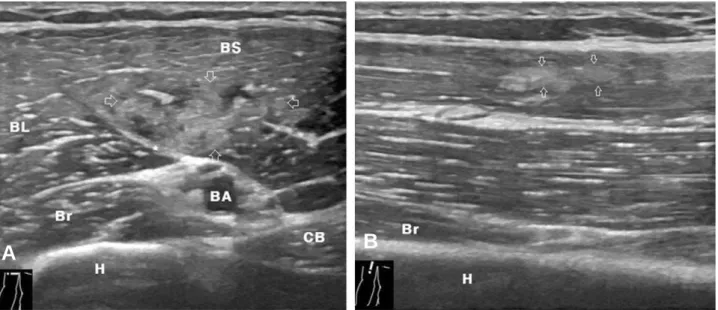 Fig. 2. Sonographic image after 5 months. (A) Transverse scan shows poorly demarcated area of increased echogenicity by fibrous healing(open arrows)