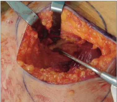 Fig. 4. After complete excision of the cyst, an opening for intraarticular  communication with the knee joint was seen, and fenestration of the  opening was done.