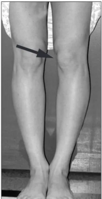 Fig. 2. The points inward (arrow) are squinting patella. This finding is  associated with femoral antevesion.