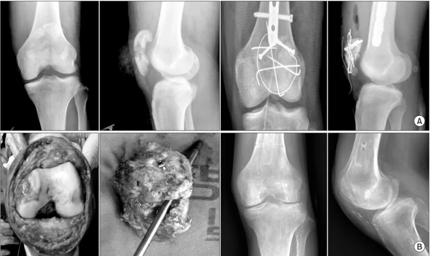 Fig. 5. Postoperative simple radiographs after patellofemoral replacement  in a patient diagnosed with patellar malunion