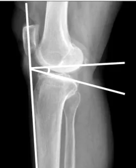 Fig. 1. A method of measuring the posterior tibial slope in this study. 