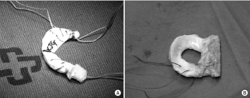 Fig. 2. The prepared fresh-frozen medial meniscal allograft by modified bone plug technique (A), lateral meniscal allograft by key-hole technique (B)