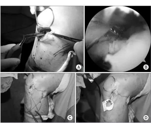 Fig. 5. (A) New device of key-hole techni- techni-que. (B) Beveling at the tunnel of posterior  horn area, by arthroscopy