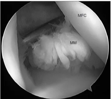Fig. 2. Under visualization through the anterolateral portal, the  anterior cruciate ligament tibial drilling guide was introduced through  the posteromedial portal