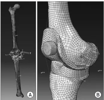 Fig. 1. (A) Finite element model of tibia and femur. (B) Finite element  model of total knee replacement.