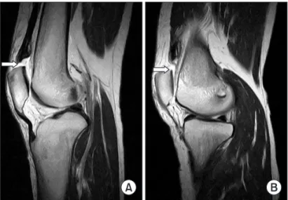Fig. 4. Bleeding bony surface at the proximal pole of a patella after  rasping.