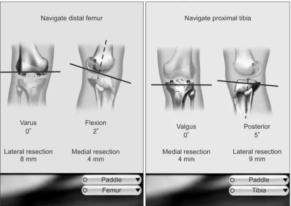 Fig. 2. Implant position angle (α: coronal medial inclination of femoral  component, β: sagittal posterior slope of femoral component, γ: coronal  medial inclination of tibial component, δ: sagittal posterior slope of tibial  component).