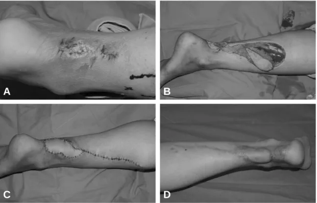 Fig. 1. Soft tissue defect on the posterior heel. (A) Right heel showed recurrent ulceration with Achilles tendon expo- expo-sure